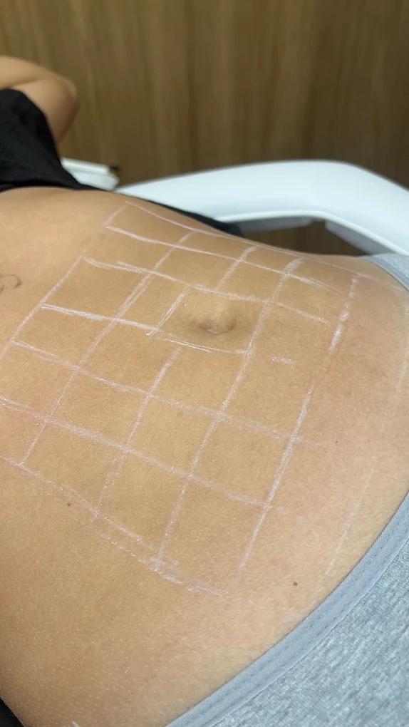 Sessão do Protocolo Código de Colágeno