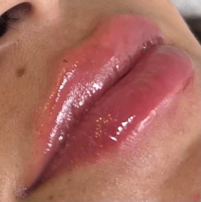 Lábios após preenchimento labial, contorno e brilho natural